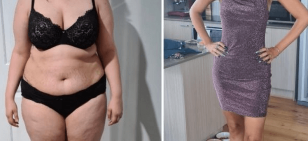 Gastric Sleeve Before and After Skin