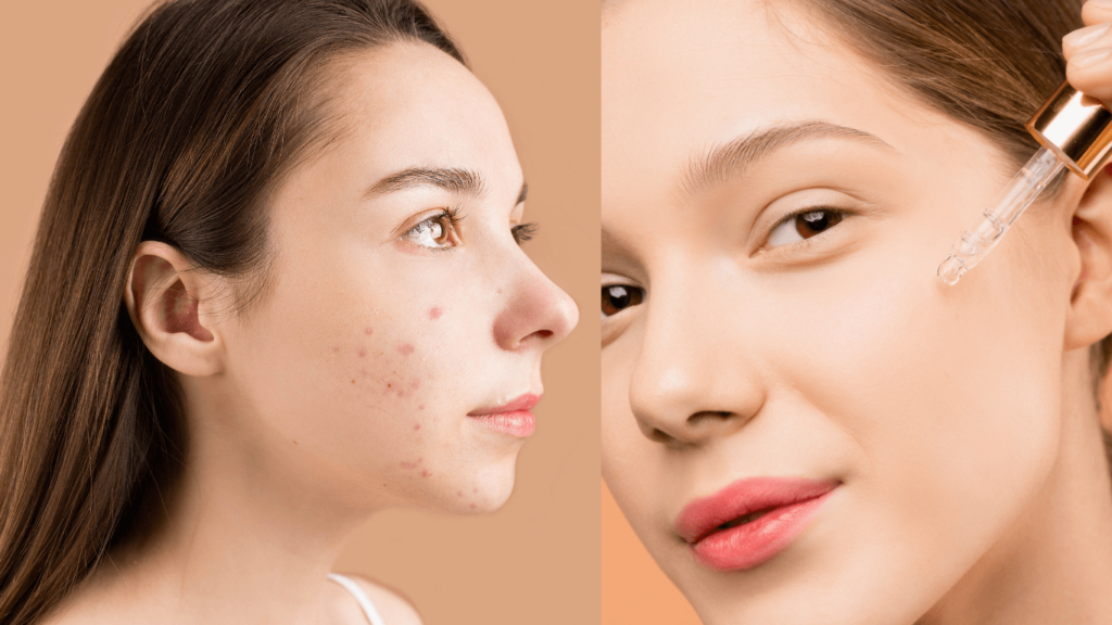 Clear Skin From Acne