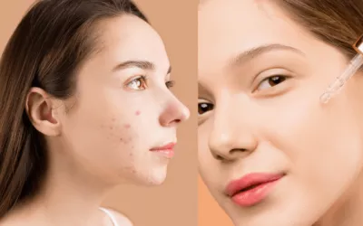 Comprehensive Guide to Banishing Clear Skin From Acne