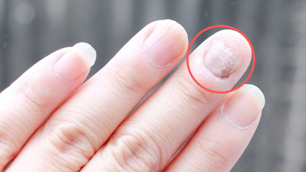Acetone Damaged Nails