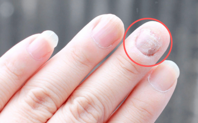 Acetone Damaged Nails: Treating & Repairing the Effects of Nail Polish Remover
