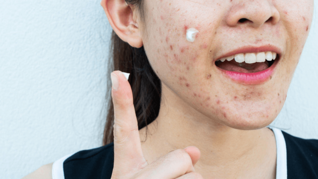 Acne from Makeup