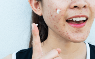 Acne from Makeup: Unveiling the Truth Behind Breakouts