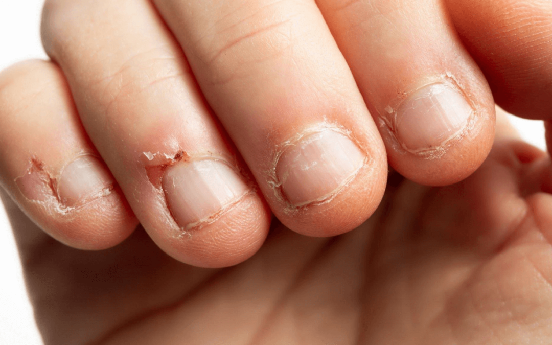 Why Do My Nails Hurt After Getting Them Done?