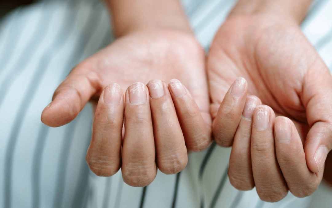 Nail Remedies