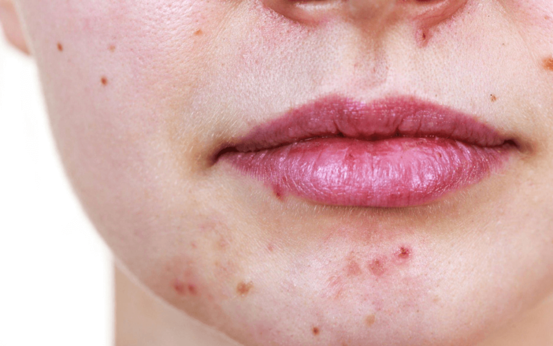 Can Lip Balm Cause Acne?