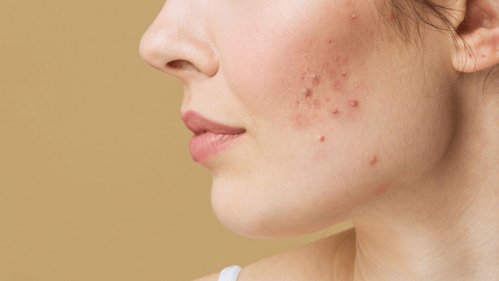 Can Makeup Cause Acne?