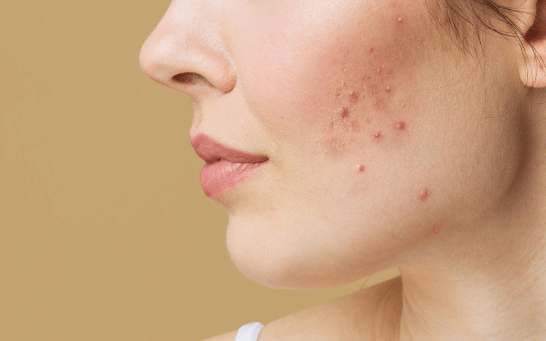 Can Makeup Cause Acne?