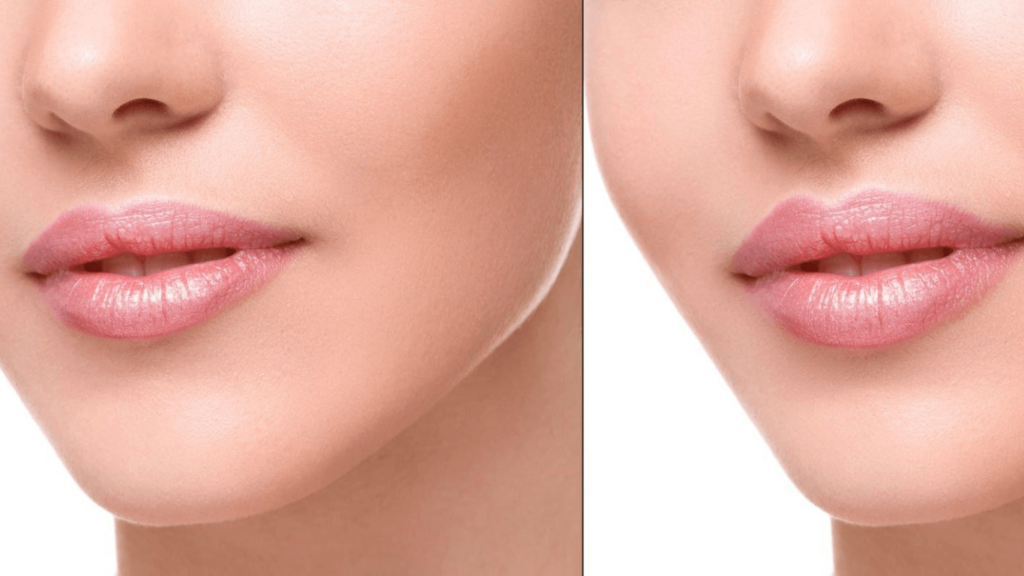 Does Lip Plumper Work Long Term?
