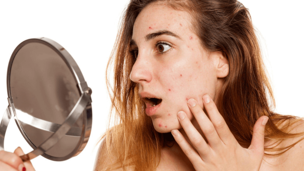 Will Makeup Make Acne Worse?