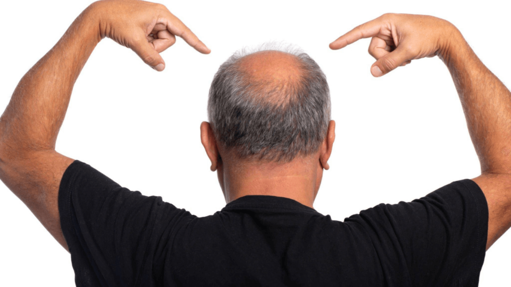Hair Loss After Wisdom Teeth Removal