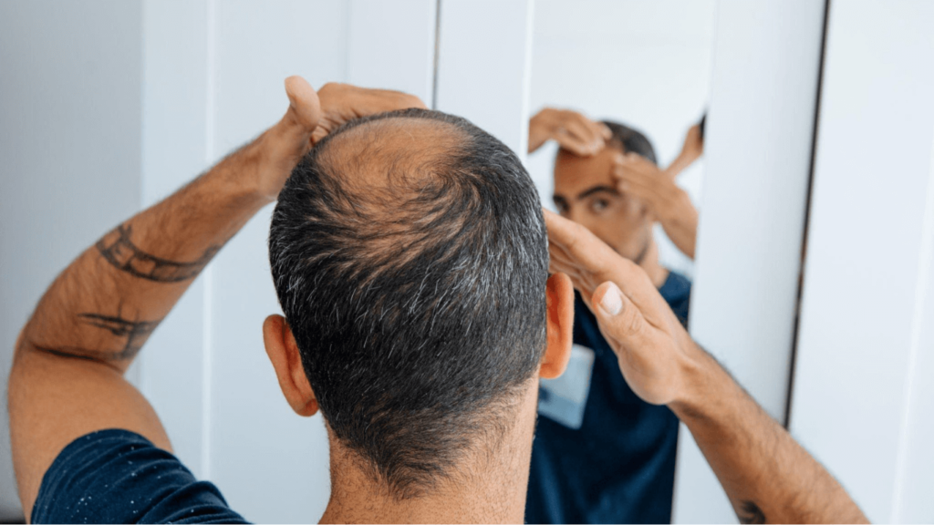 How to Prevent Shock Loss After Hair Transplant