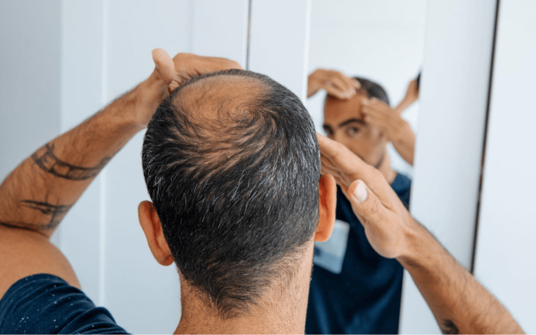 How to Prevent Shock Loss After Hair Transplant