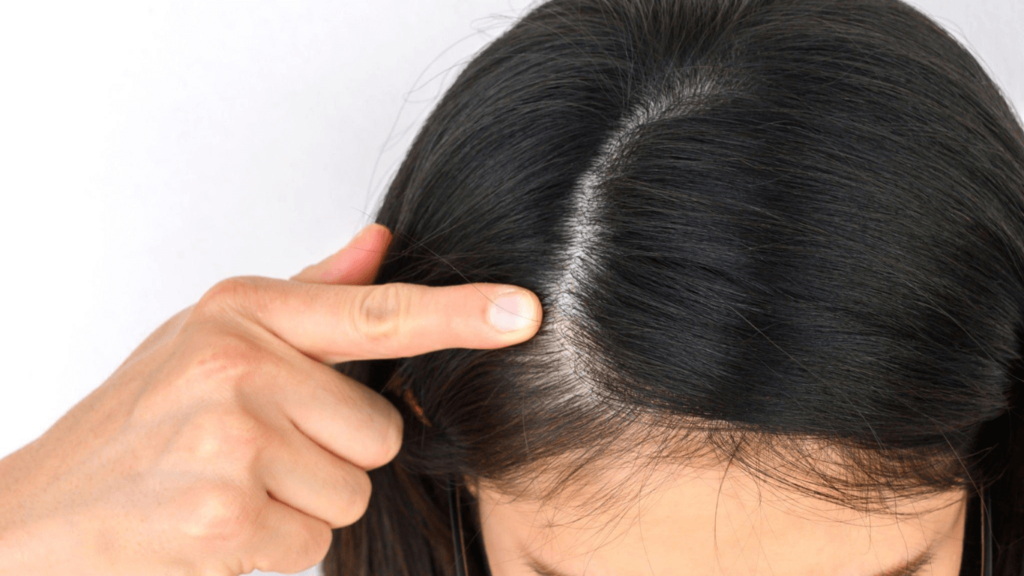 Lanreotide Hair Loss