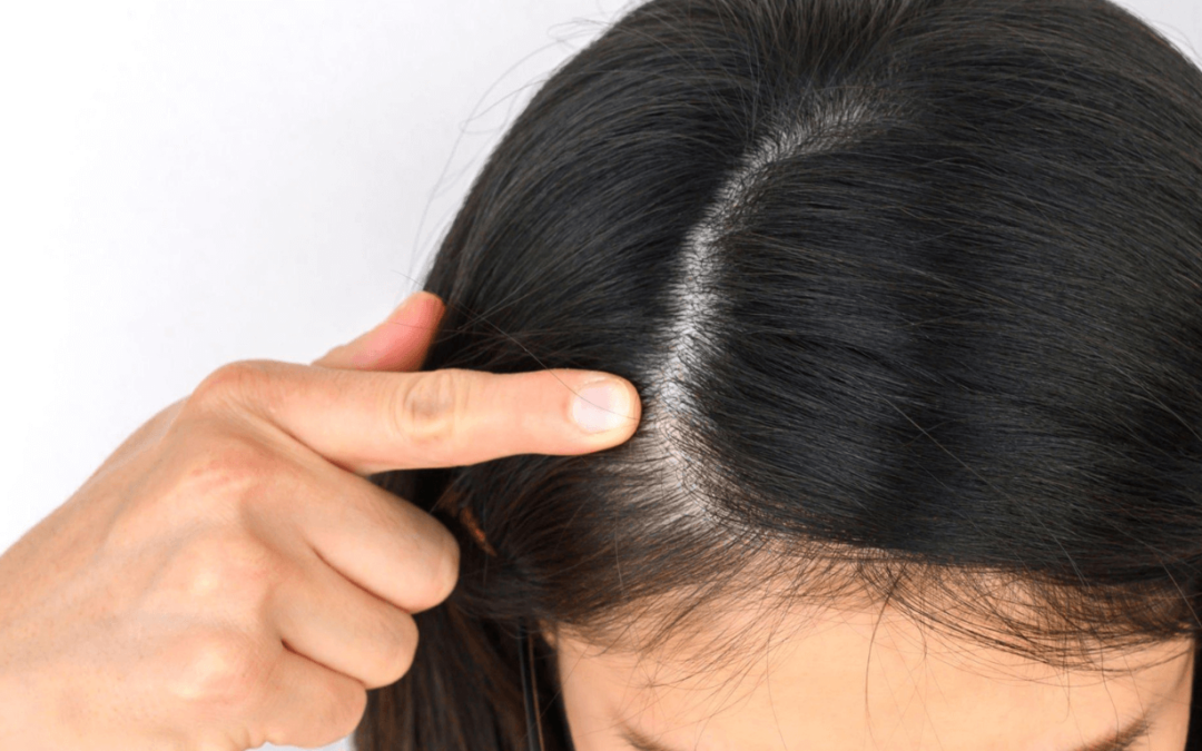 Lanreotide Hair Loss