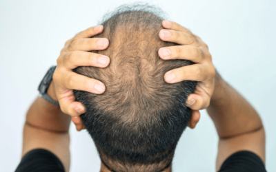 Numan Hair Loss Solutions: Reclaiming Your Confidence