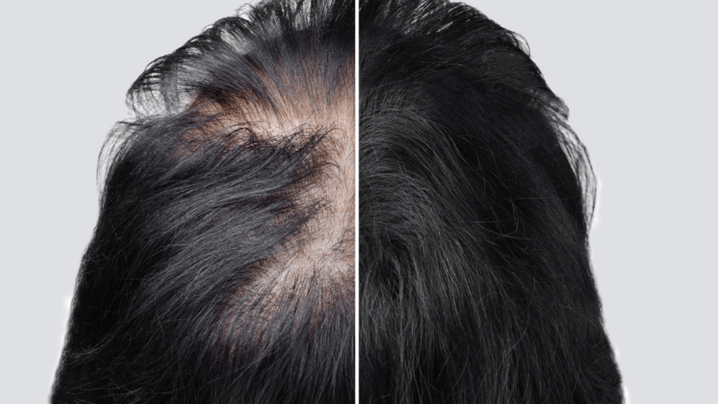 Trileptal Hair Loss