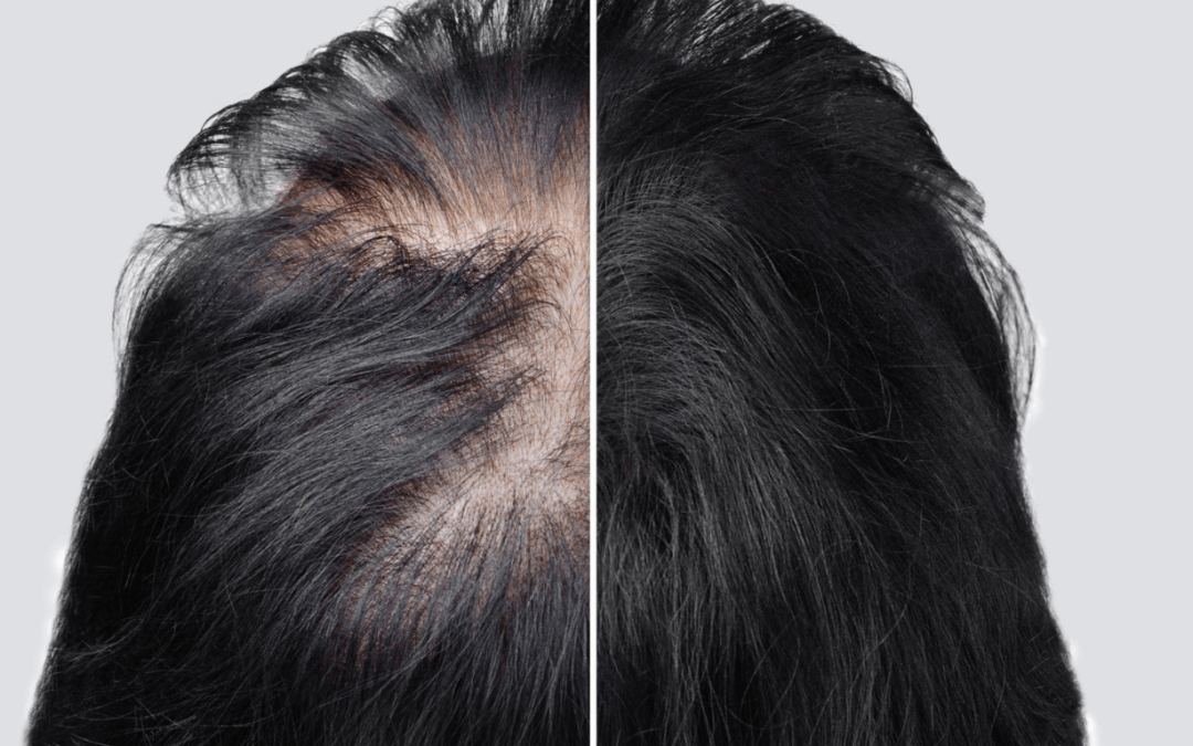 Trileptal Hair Loss
