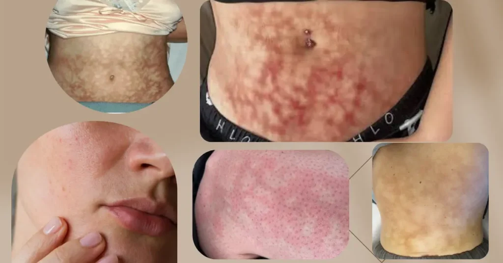 Toasted Skin Syndrome