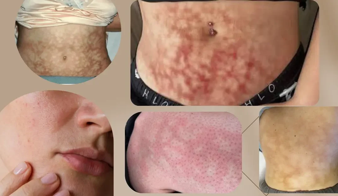 Toasted Skin Syndrome